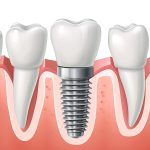 Dental Implants Essex