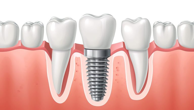 Dental Implants Essex