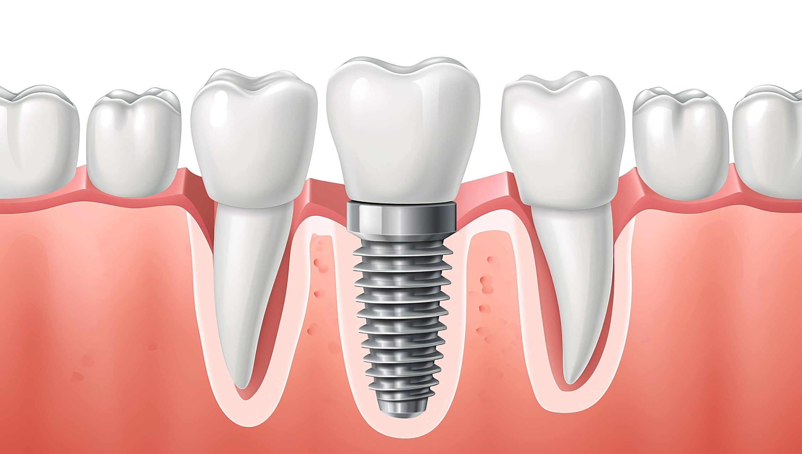 Complete guide to understanding dental implant procedures and the recovery process